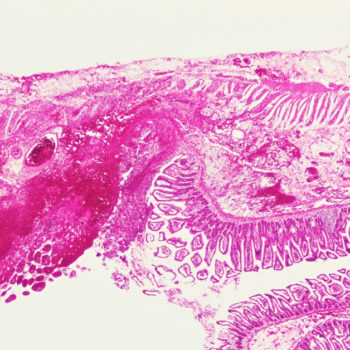 Patient Advisory Board Crohn’s Disease